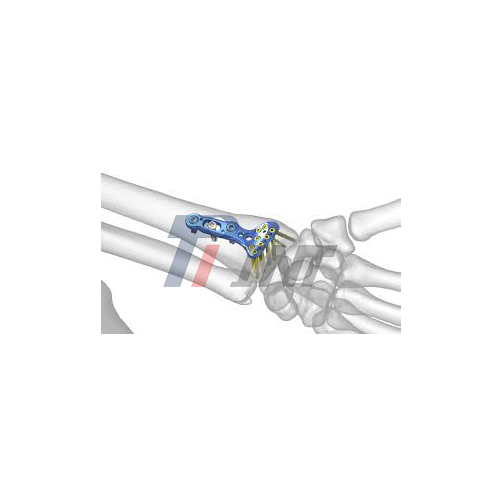 titanium humerus plate supplier